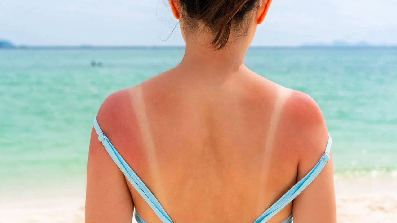 piel-quemada-sol_962454ad_230726133118_1280x720